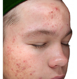 before IV Peel