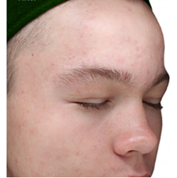 After IV Peel